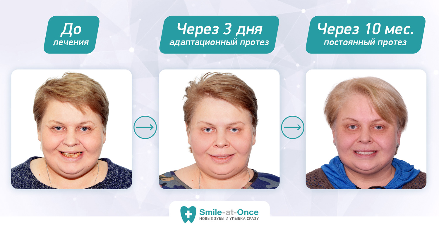 Молодцова Елена после победы в акции Трансформация улыбки