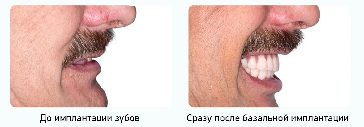 граница десны совсем не видна при улыбке
