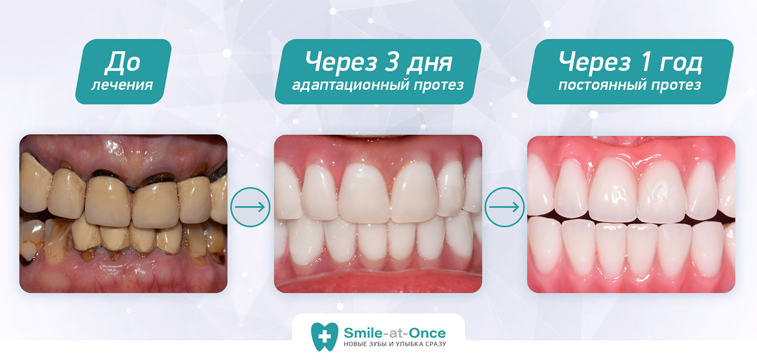До и после имплантации зубов