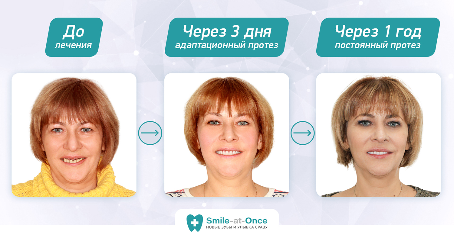 Ольга Пыхова после базальной имплантации зубов