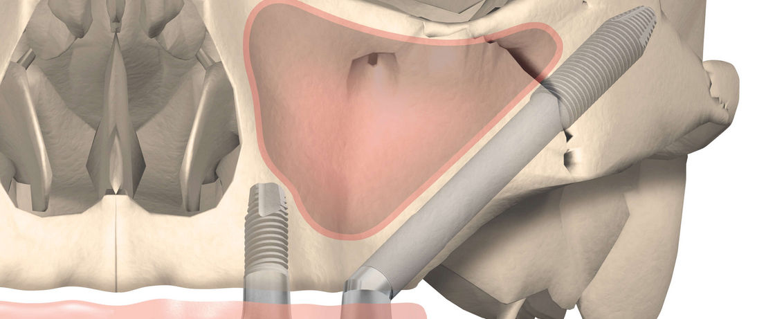 Имплантация жевательных зубов Zygoma segment