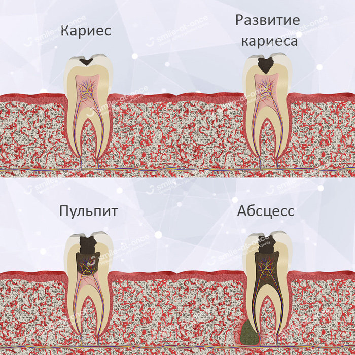 Запущенный кариес может привести к развитию абсцесса Абсцесс зуба