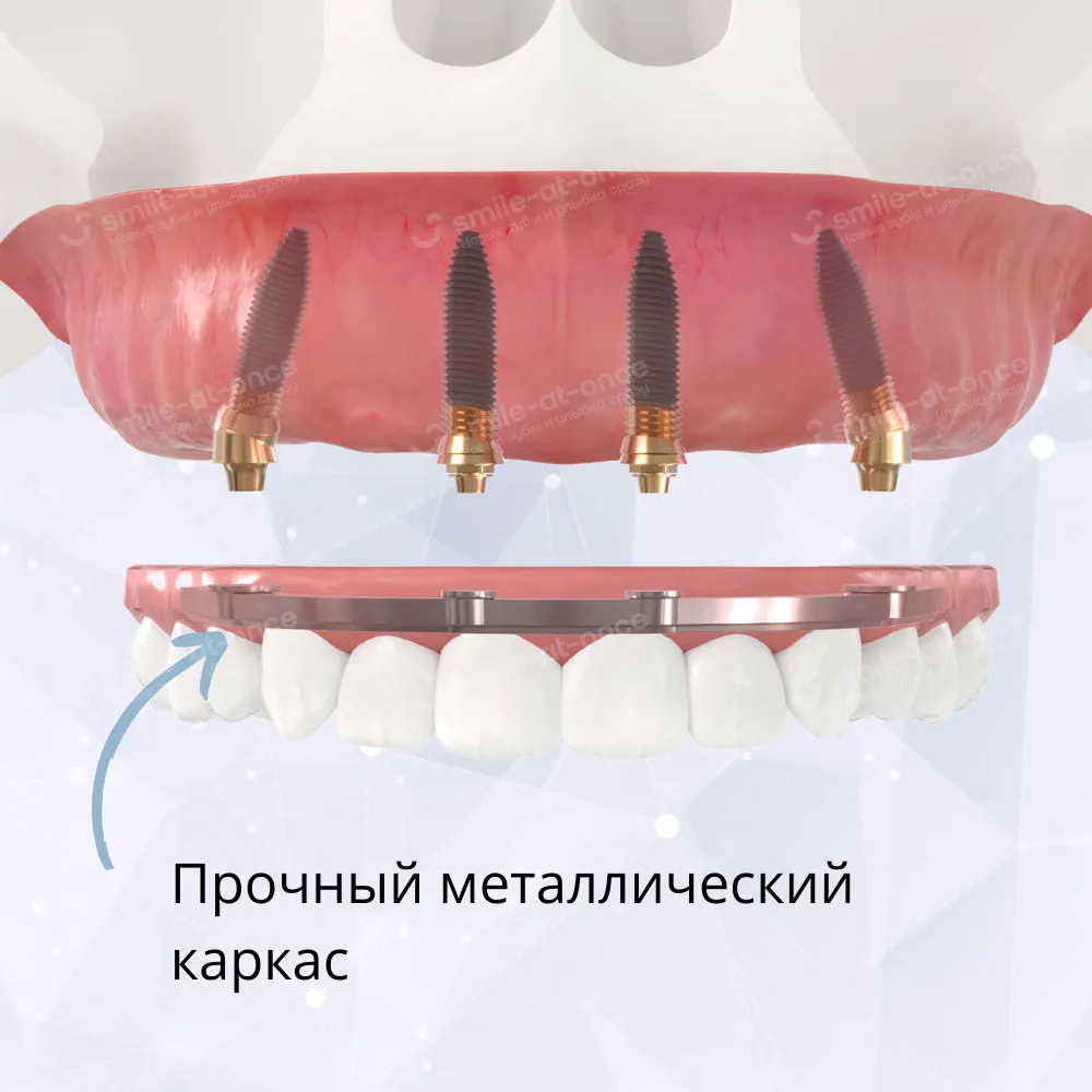 Адаптационный зубной протез на каркасе