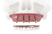 All-on-4 – все зубы на 4 имплантах Nobel Biocare или Straumann