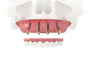 All-on-4 – имплантация всех зубов