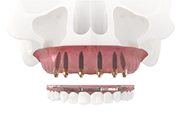 All-on-6 – все зубы на 6 имплантах