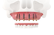 All-on-6 – имплантация всех зубов