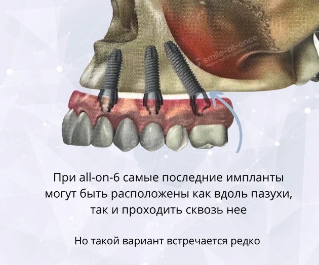 Имплантация зубов all-on-6