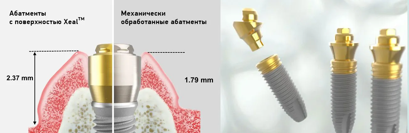 Сравнение абатментов зубных имплантов