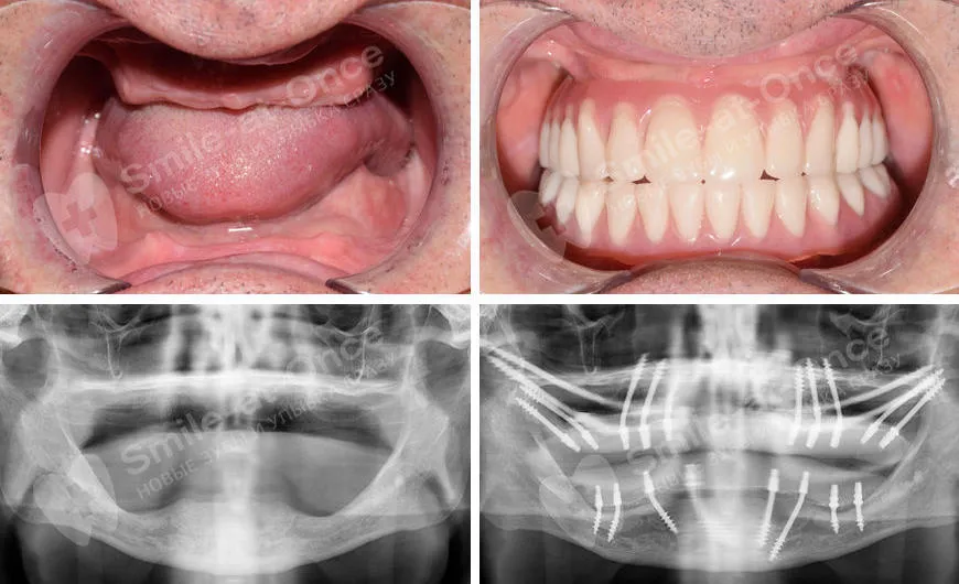 одноэтапная имлантация для восстановления зубов