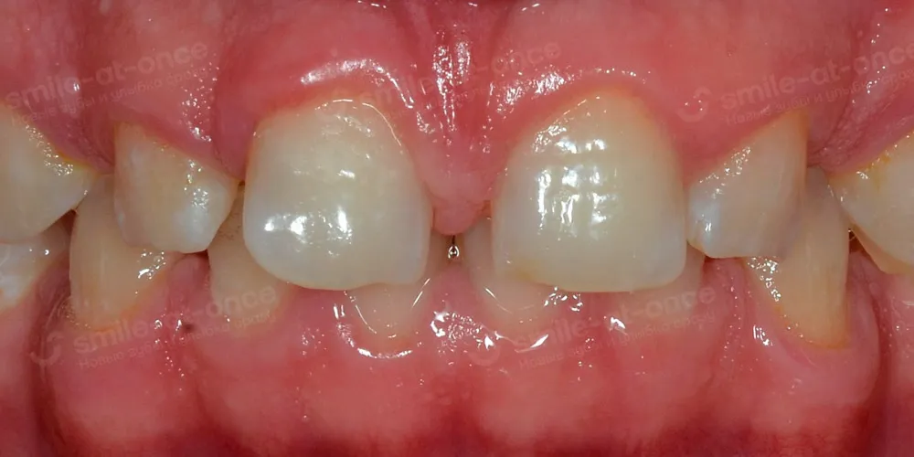 щель между зубами как исправить