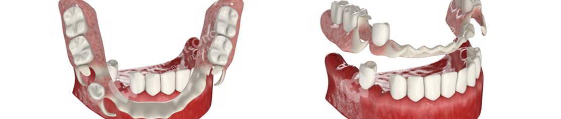 Съемные зубные протезы