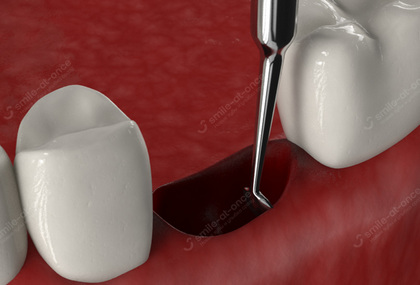 Очищение лунки зуба хирургическим способом