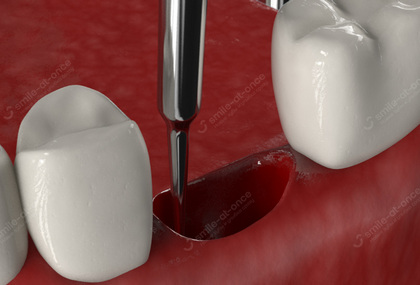 Очищение лунки зуба хирургическим способом
