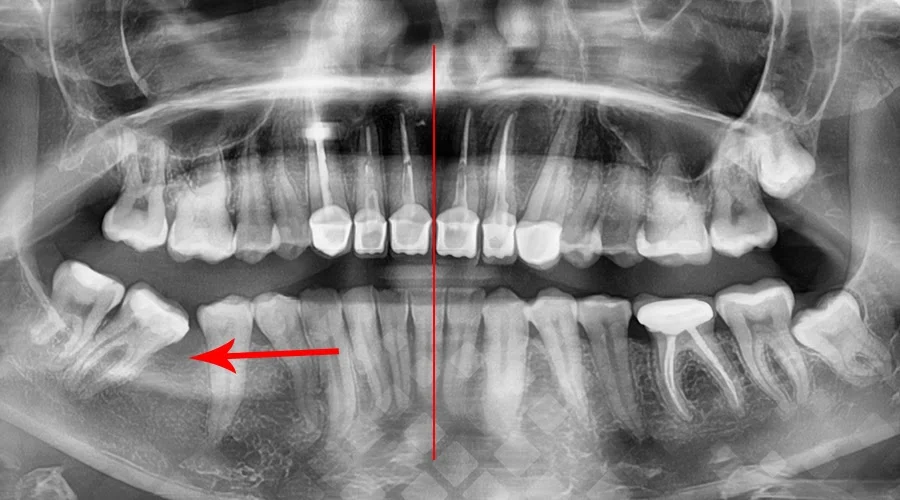 Рентген снимок с отстутствующим зубом