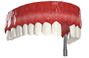 имплантация переднего зуба