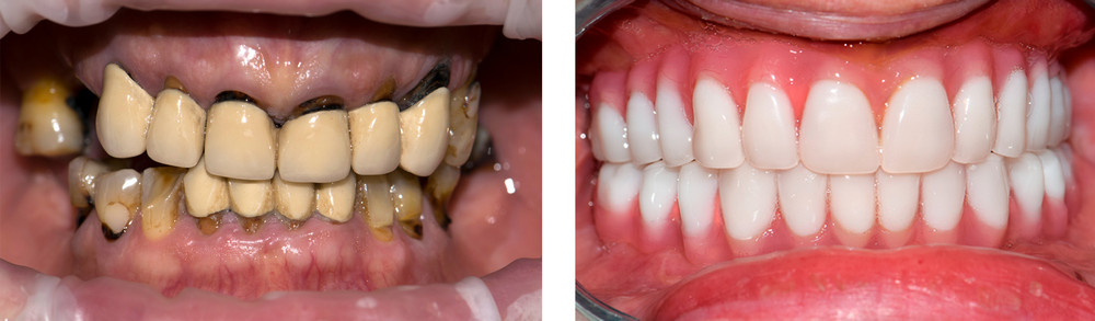 до и после имплантации фото зубов