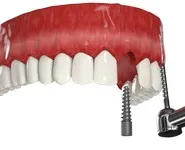 имплантация с отстроченой нагрузкой переднего зуба
