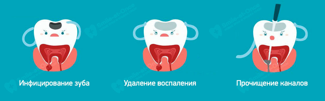 Этапы эндодонтического лечения каналов зуба