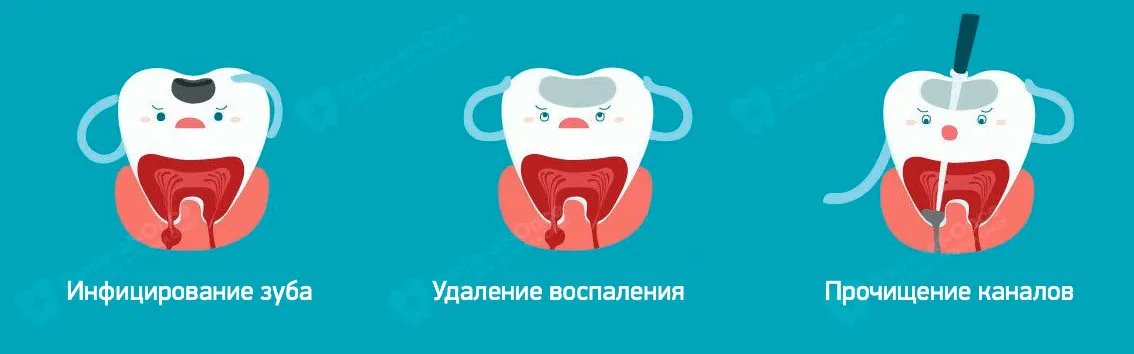 Этапы эндодонтического лечения каналов зуба