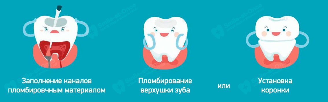 Этапы лечения каналов и нерва зуба