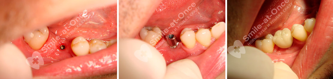 Пример установки импланта alpha dent