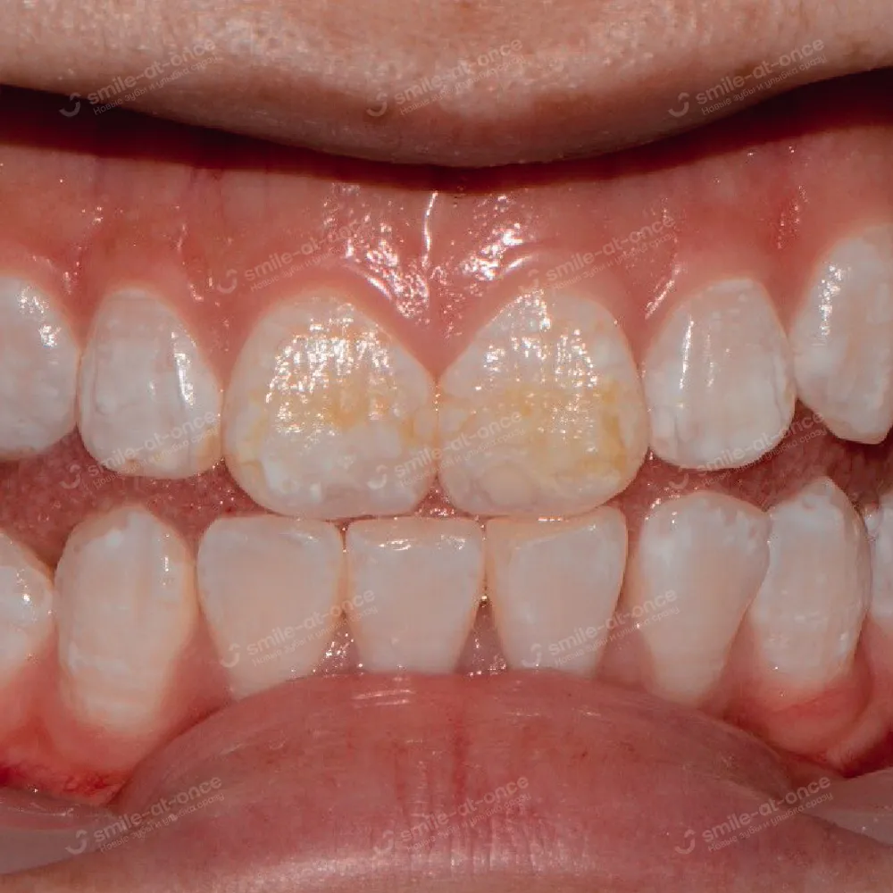 Зубы при флюорозе
