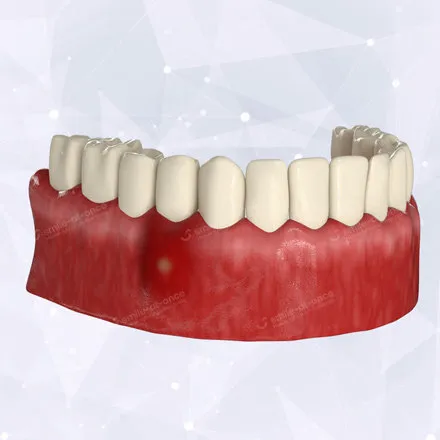 Флюс или абсцесс зуба