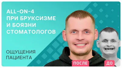 Видео - Имплантация зубов при бруксизме и панической боязни стоматологов