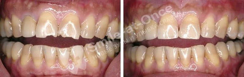 Художественная реставрация зубов до и после