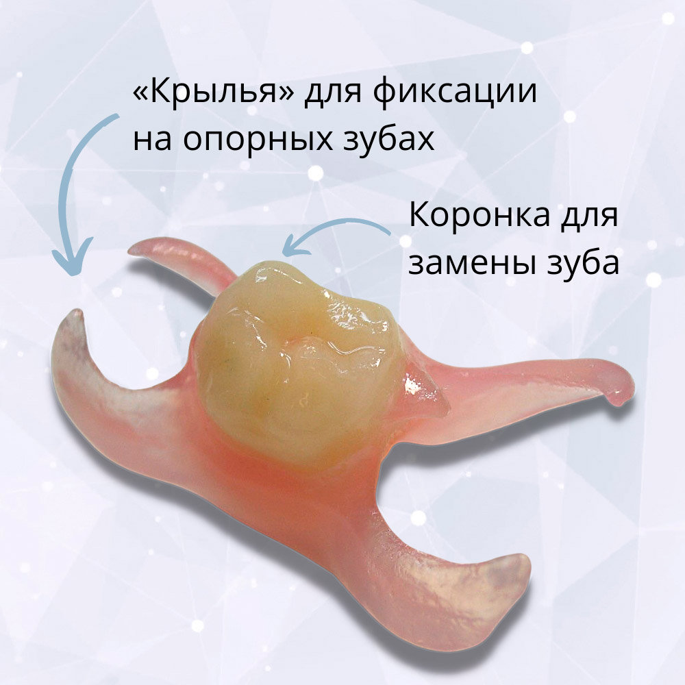 Иммедиат протез бабочка