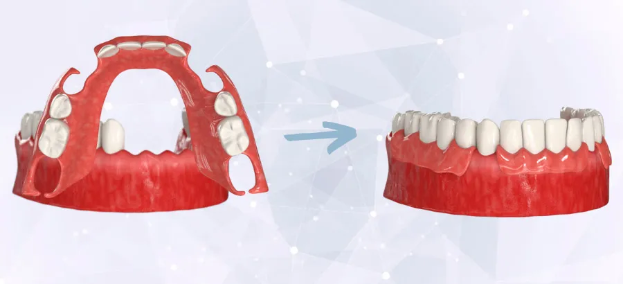 Частичный иммедиат-протез – для нескольких зубов