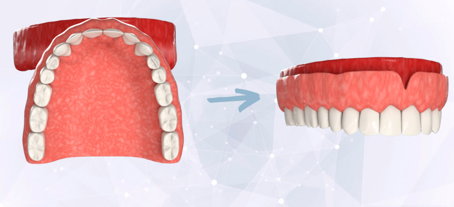 Полный иммедиат-протез для восстановления всех зубов