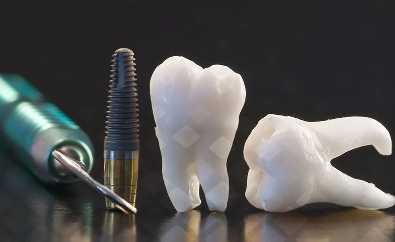 Зубные импланты вместо родного зуба