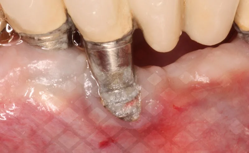 Процесс отторжения зубных имплантов