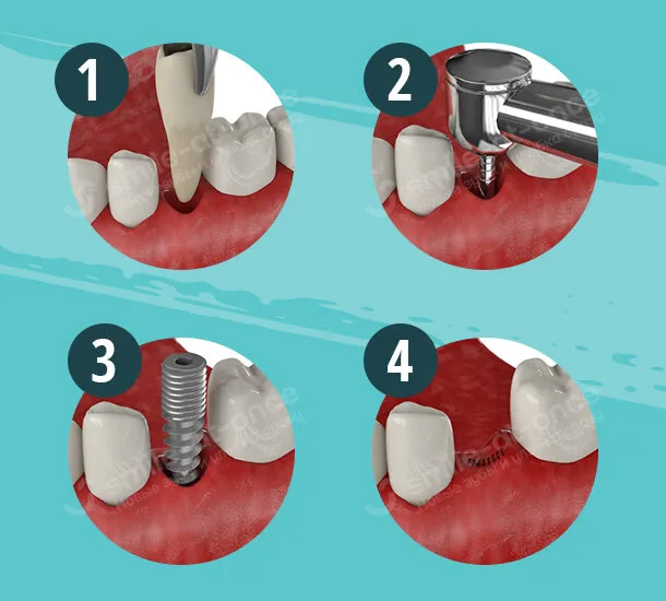 Этапы одномоментной имплантации в лунку удаленного зуба