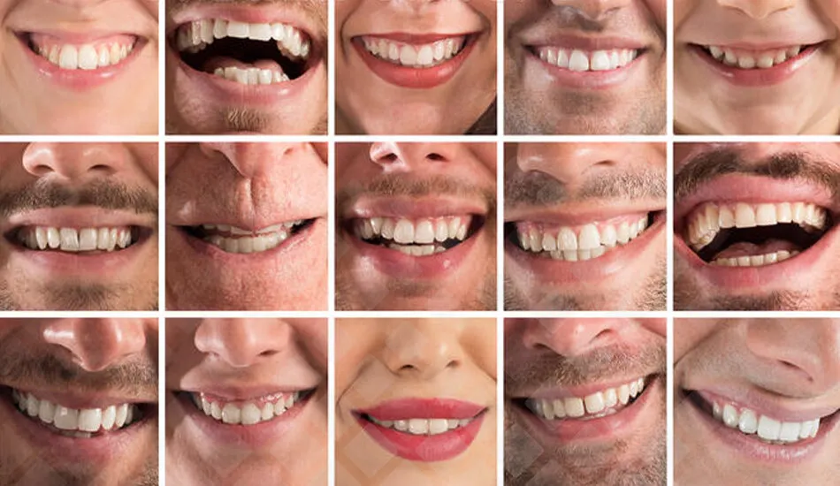 Улыбки людей после имплантации зубов