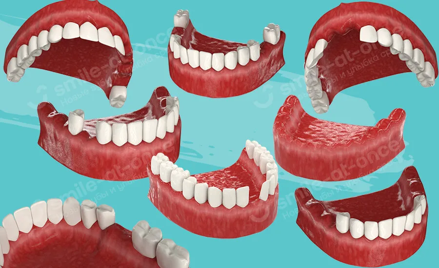 Разные ситуации, требующие имплантации зубов