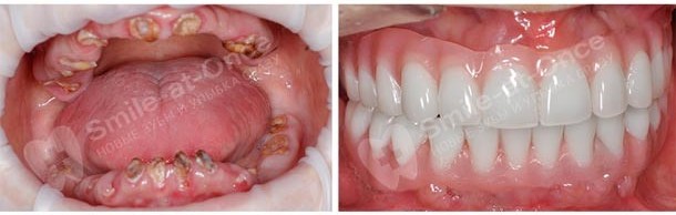 имплантация при сильных заболеваниях зубов