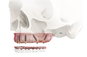 Имплантация V-II-V для верхней челюсти