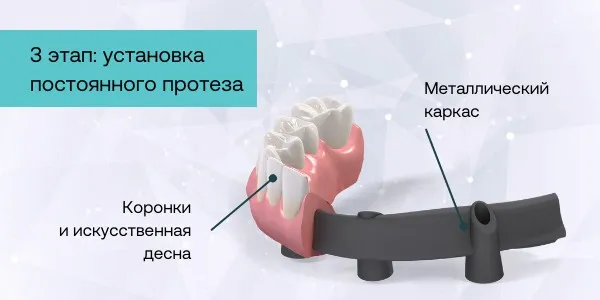 Установка постоянного зубного протеза