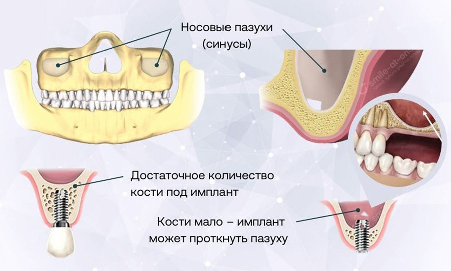 Особенности имплантации верхней челюсти