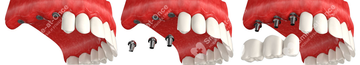 Схематический пример имплантации зубов