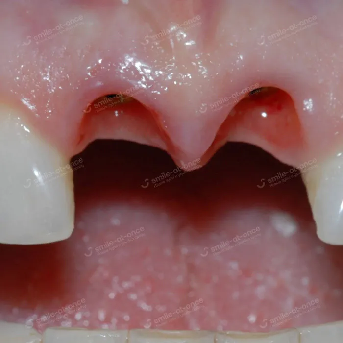 Причины потери передних зубов