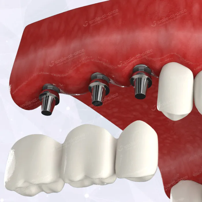 Импланты на сегмент отсутствующих зубов на верхней челюсти