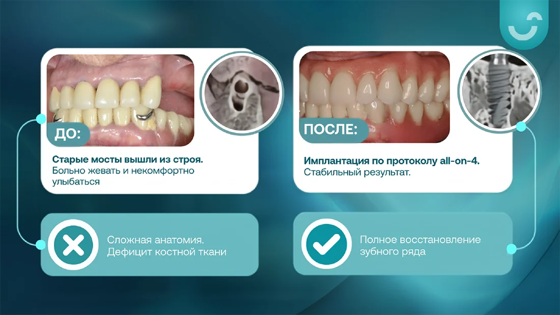 Результаты до и после лечения зубов