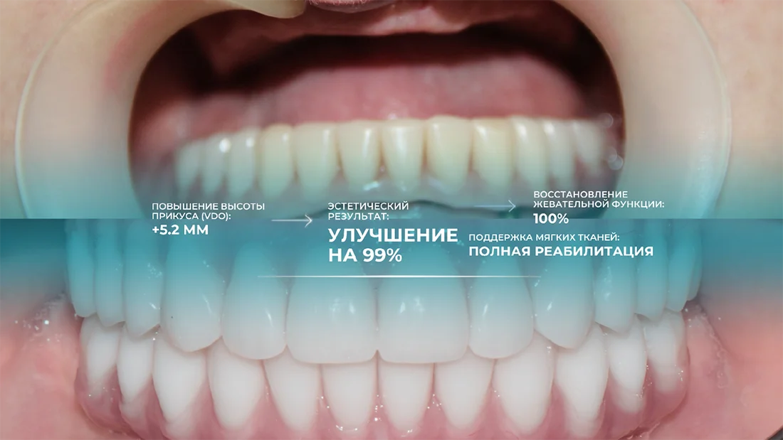 Результат проведения имплантации