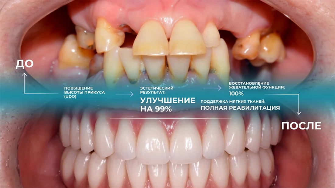 Как изменились зубы после имплантации