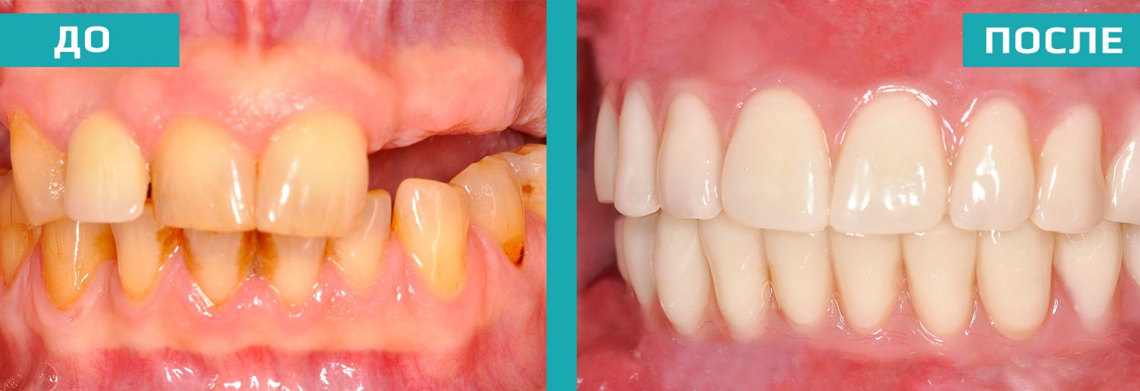 Зубы до и после операции
