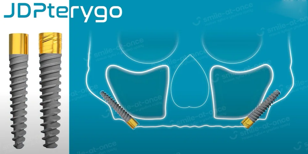 JDPterygo — птеригоидные импланты
